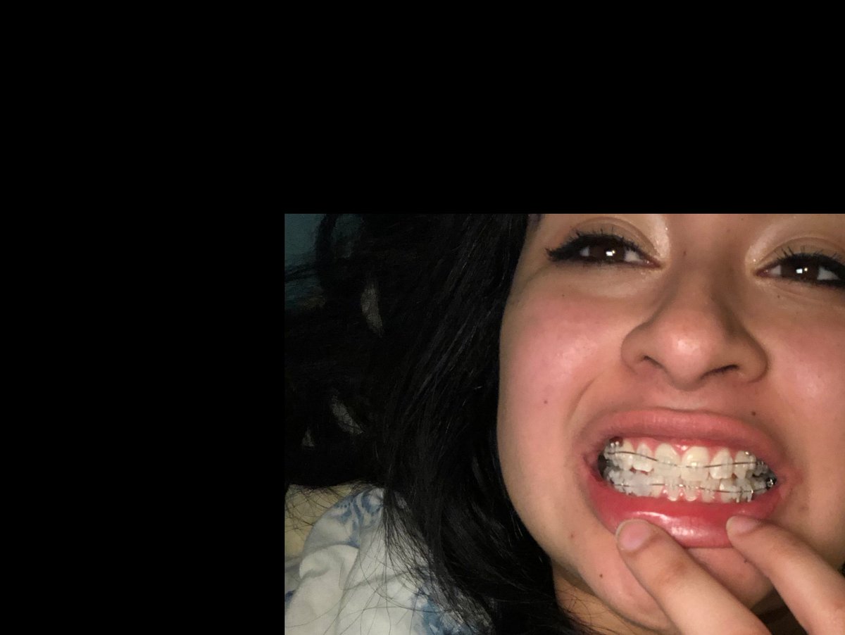 LittleCheb's tweet image. I got braces. So ouch.