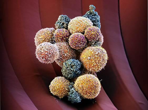 Científicos suizos descubren una forma de separar en grupos las células tumorales que circulan por la sangre e impedir que formen metástasis del cáncer de mama.