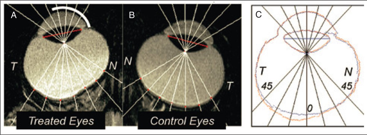 ChanOptometry's tweet image. Not Focusing on Myopia Is Shortsighted
 bit.ly/2V11Nq6 
Contact Chan Optometry for eye exams and optometry services. Visit us at chanoptometry.com or Call us at (905) 604-6856. 
#ChanOptometry #eye #scarborough