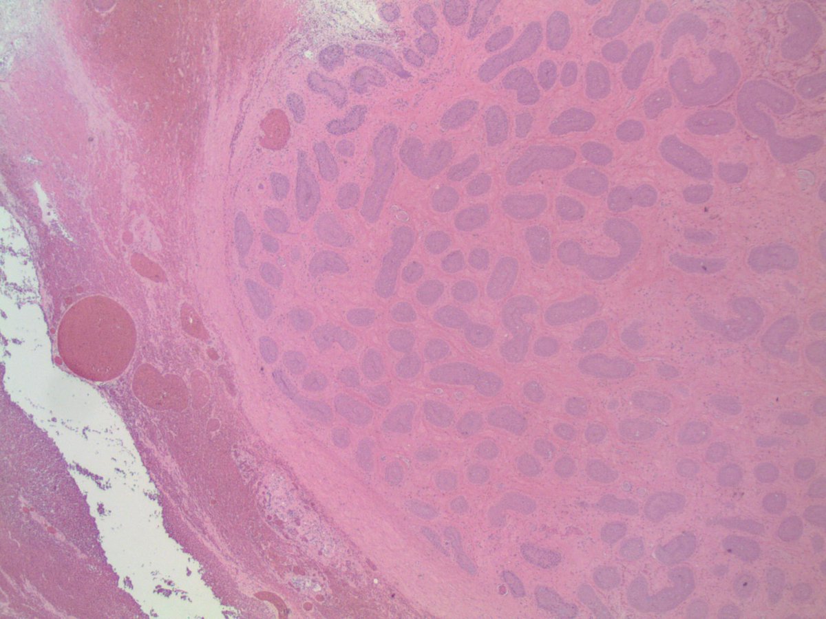 slusagar's tweet photo. #LPpath #Pathstories ๐ฌ
organ/Dx/clinical presentation?
(sorry, my @ventana scanner is on the fritz, AGAIN, so have to go old school and take pics off my scope camera...couldn't get my usual fav 1x lowpower path shots I love to take off the scanner) https://t.co/yrKmyhMpKC