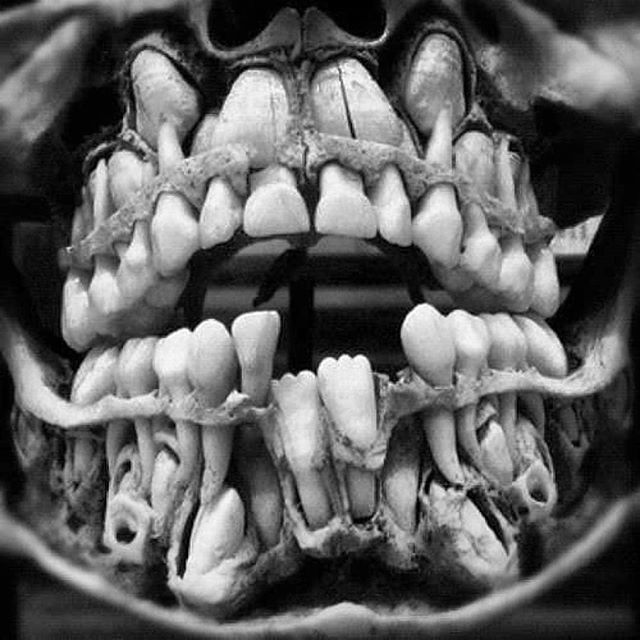 alldentfor's tweet photo. Perfect antique dental dissection
#anatomystudy #dentist #primaryteeth #milkteeth #enamel #medicalprep #antiqueshops #tattooreference #muttermuseum #blackandwhite #osteology #anthropology https://t.co/NFLsWxTMEh https://t.co/4Q05su5iLT