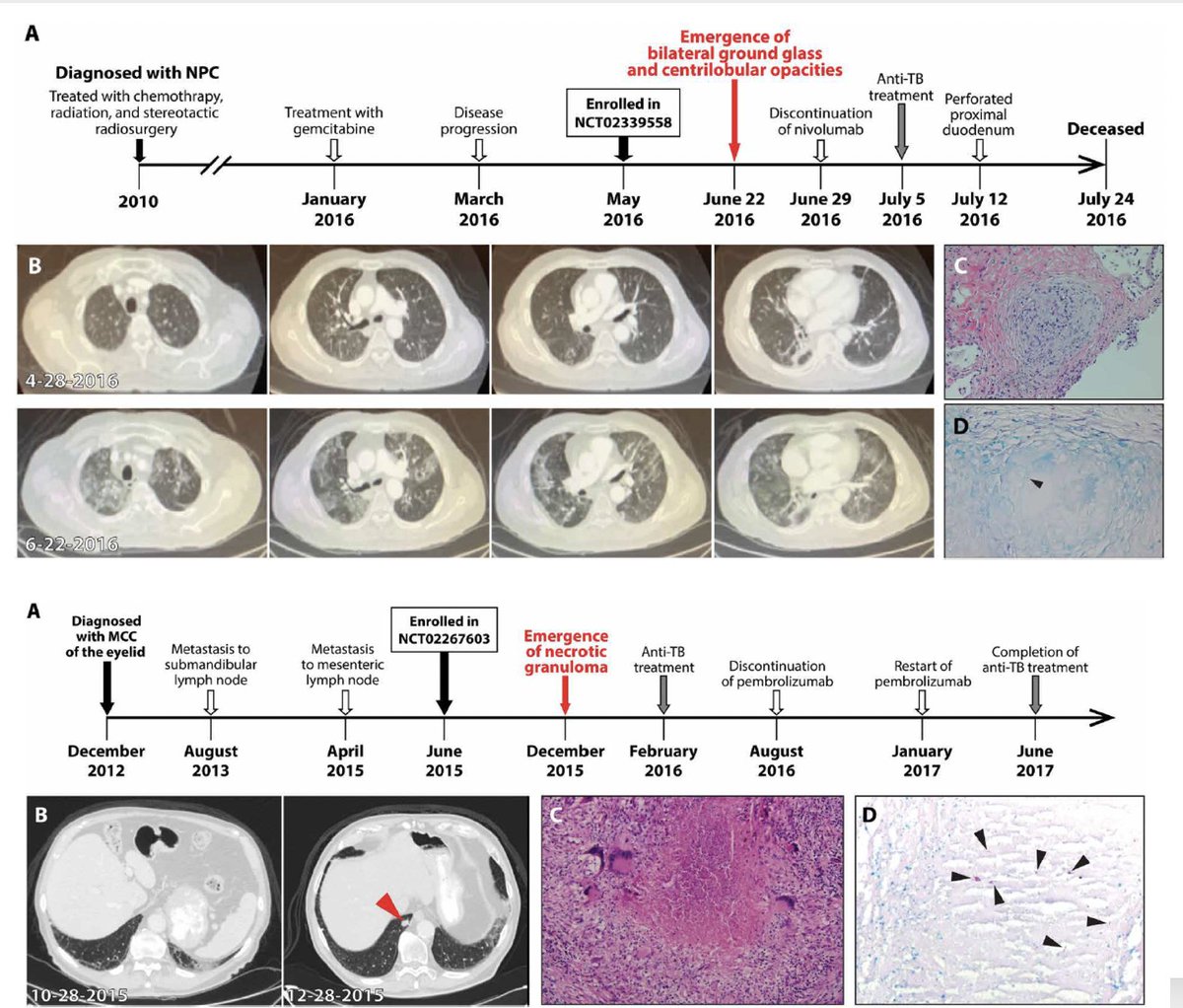 EricTopol's tweet image. Tuberculosis worsened by immune checkpoint inhibitor therapy stm.sciencemag.org/content/11/475…
(it was thought revving up the immune system would be helpful)
@ScienceTM by @EladSharonMD and colleagues