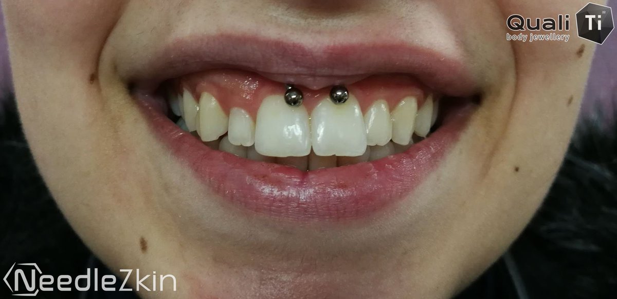 NeedleZkin's tweet photo. [FR] Smiley freehand pour Chloé avec un bijoux de chez QualiTi
[EN] Smiley freehand method for Chloe with a jewelry from @qualitibodyjewellery
#France #Toulouse #Piercer #PiercerLife #Piercing #NeedleZkin #Smiley #Freehand #QualiTi #Quality #TBT #GirlsWithPiercing #PiercedGirls https://t.co/zmXU2aQgpQ
