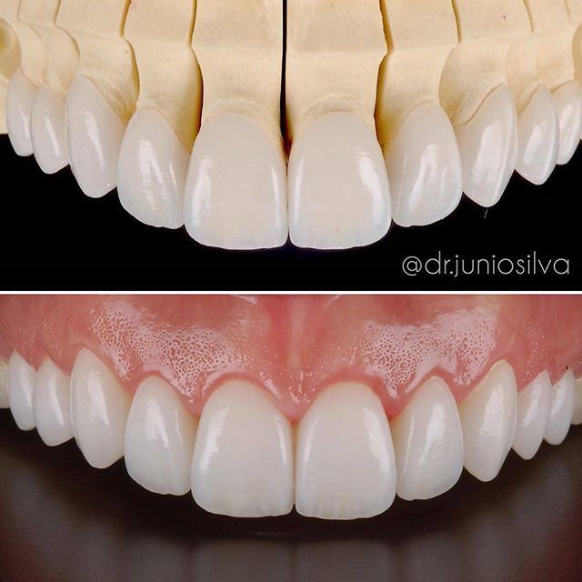 alldentfor's tweet photo. O planejamento e a execução  de casos como este ilustrado devem se encontrar em perfeita harmonia. Assim o paciente e a equipe profissional tem total controle da previsibilidade do novo sorriso! Sem surpresas ! Conjunto de facetas clássicas, estendidas e… https://t.co/HR7eFGEWqg https://t.co/niEhKdInef