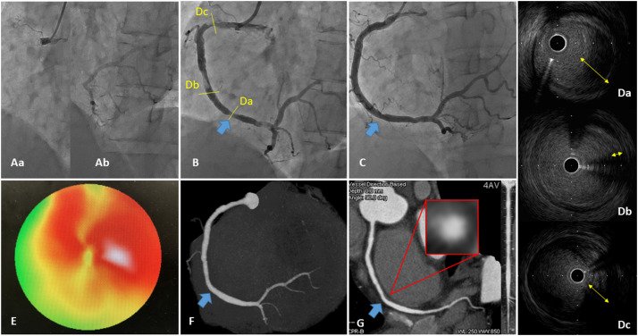 CRMjournal (@CRMjournal) on Twitter photo 2019-01-22 17:20:00 #Stentless strategy in #primaryPCI setting: An alternative strategy in some #clinical scenarios? by Kazuhiro Dan, @hect2701, Akira Shinoda and @ron_waksman in #casereports supplement bit.ly/2LHCtQ9 #Stentless strategy in #primaryPCI setting: An alternative strategy in some #clinical scenarios? by Kazuhiro Dan, @hect2701, Akira Shinoda and @ron_waksman in #casereports supplement bit.ly/2LHCtQ9