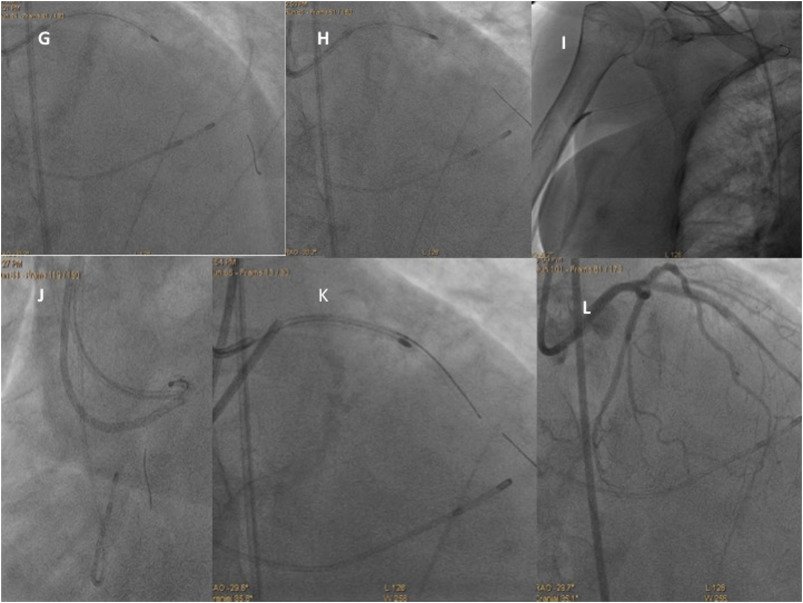 CRMjournal's tweet image. #STEMI under-expanded #stent, stuck #Rotablator burr and successful retrieval by using a mini STAR technique by Neisser Morales-Victorino et al. in #casereports supplement bit.ly/2jvkSj1