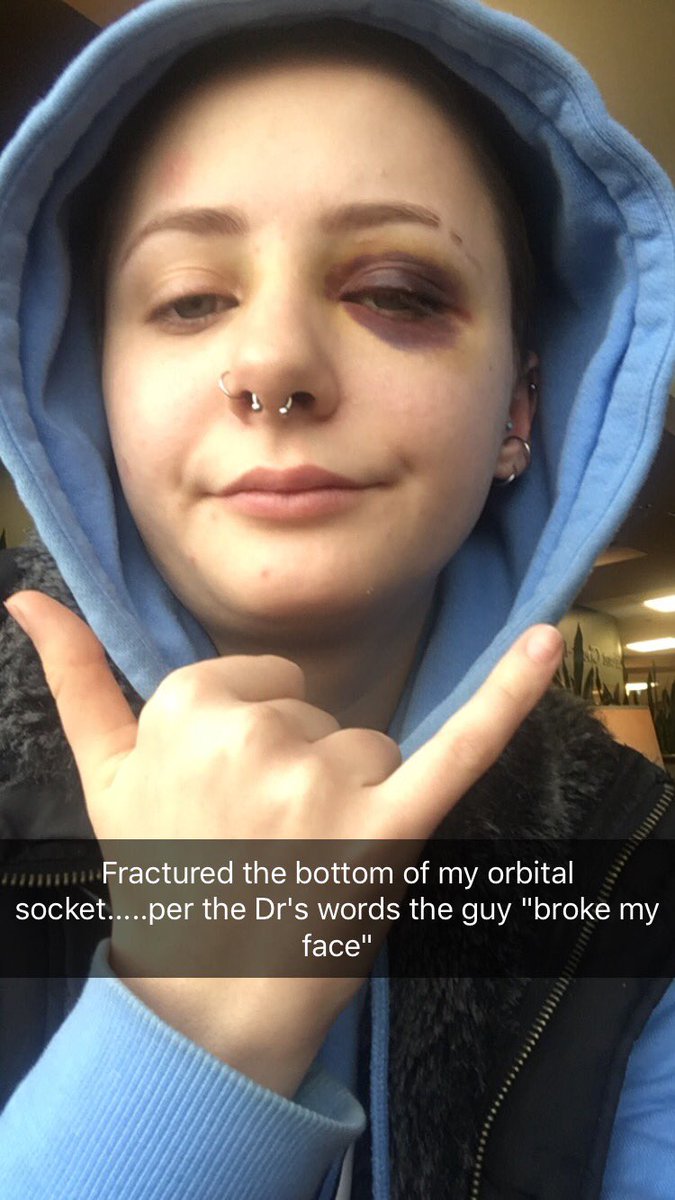 I wasn't gonna tweet abt this but considering I had to get a CT scan of my skull yesterday....last Sat in Denver a man in the street grabbed my chest so I kicked him away from me, at which point he punched me in the face hard enough to fracture my orbital socket &amp; (thread)