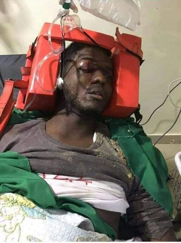 hassan_ahmed199's tweet photo. السلام عليكم 
زملينا الفاتح في الجامعة(هندسة ميكانيكا السنة الخامسة) اتعرض لي اصابة في عينه برصاص مطاطي اثناء مظاهرة بري و قررو ليو عملية 
الناس تحاول تساهم معانا 
ارقام التحويل 
0912910975
0121570557
#مدن_السودان_تنتفص 
#تسقط_بس 
#موكب17يناير https://t.co/gEGtztoVO0
