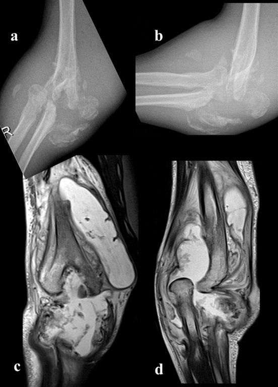 pediatricsresj's tweet photo. Congenital Insensitivity to Pain Syndrome with Anhidrosis. Review of Literature
Read More: https://t.co/5KbIiutW6r
#Congenitalinsensitivitytopain #Paininsensitivity #Anhidrosis #SensoryNeuropathy #Charcotjoint #Arthropathy #Osteomyelitis https://t.co/oYnCnrH3Oc