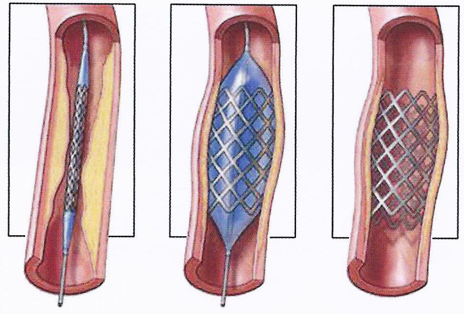 Коронарное стентирование сосудов сердца. Стентирование сосудов артерии. Стентирование коронарных артерий схема. Протокол операции стентирование коронарных артерий. Стентирование сосудов сердца.