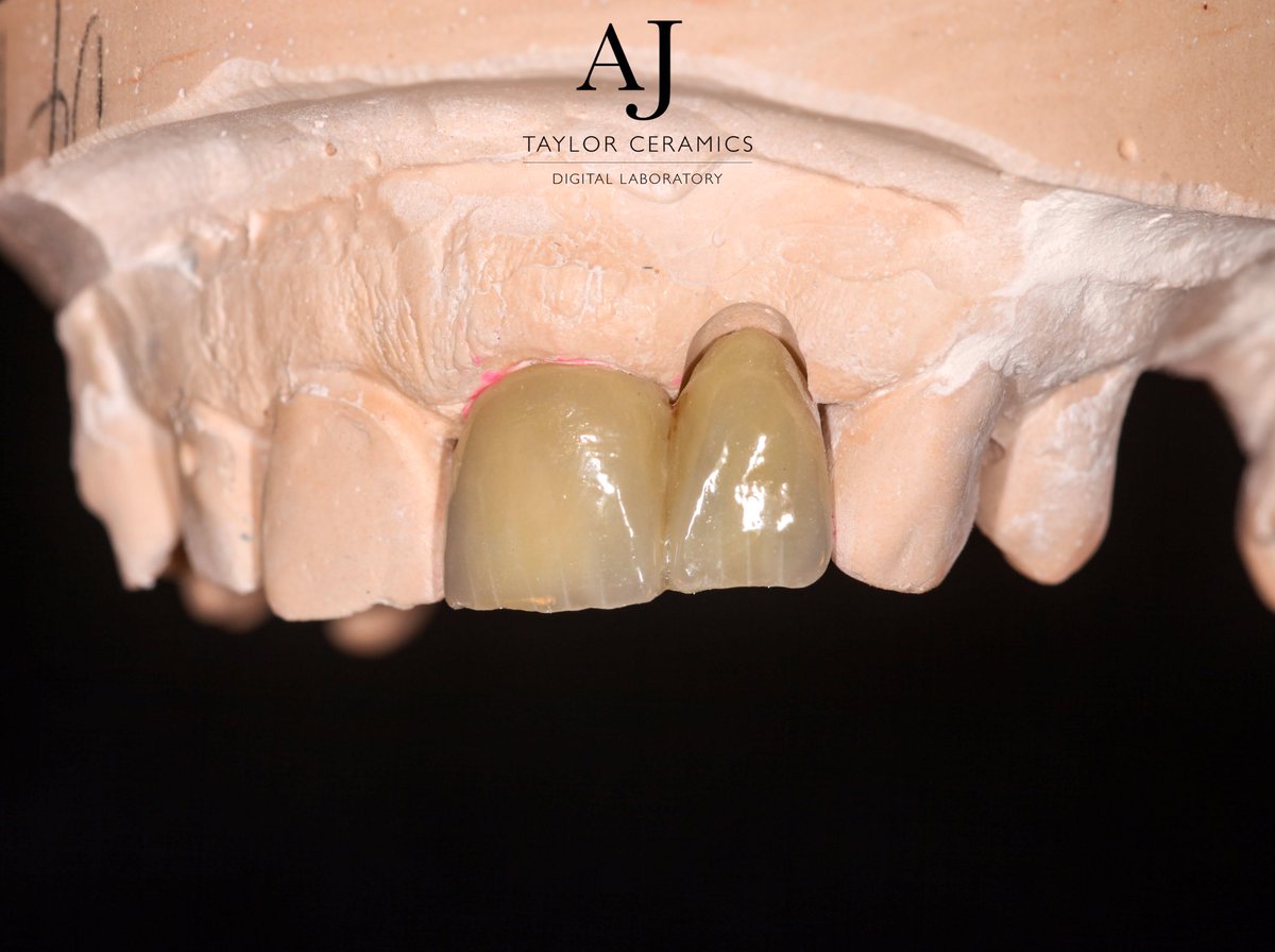 Zirconia porcelain bonded bridge with enamel cracks #Dentist #zirconia #porcelain