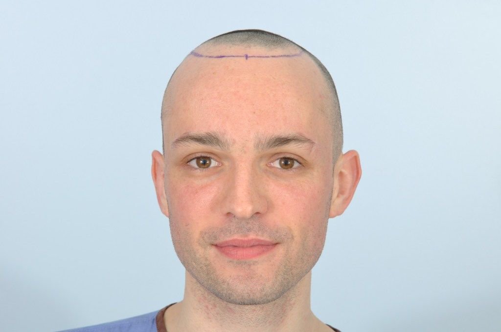 HRBRDublin's tweet photo. Irish social media star and television presenter, @JamesKavanagh_ recently attended HRBR in Dublin, Ireland for an FUE hair transplant. Read this blog to find out how James got on, and what research he did in the lead up to his transplant. https://t.co/ye1VQO1JPa #jameskavanagh https://t.co/hplRJMMVoE