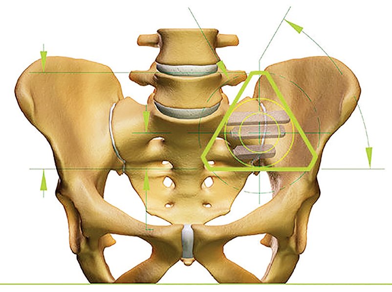 Bryan_Health's tweet photo. The new #iFuse implant brought Suzanne Nitz #pain relief beyond her wildest imagination. Read how Drs. Steven Gogela and Robert Vande Guchte relieve chronic #back pain related to #arthritis or excessive flexibility of the sacroiliac (SI) joint.
https://t.co/QZIas483aU #LNK https://t.co/rsvHGaLb69