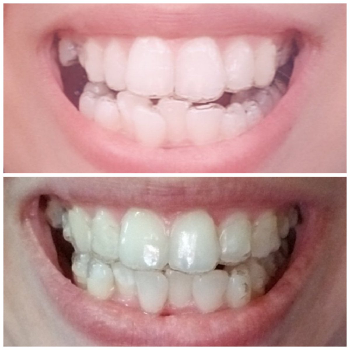 shands87's tweet photo. #invisalignsmile #invisalign 
Tray top 1
Tray bottom 15 loving my improvements especially with that top poke out tooth is starting to move ekkk 
Thank you invisalign for coming to my life! https://t.co/OyXG8Hzgzu