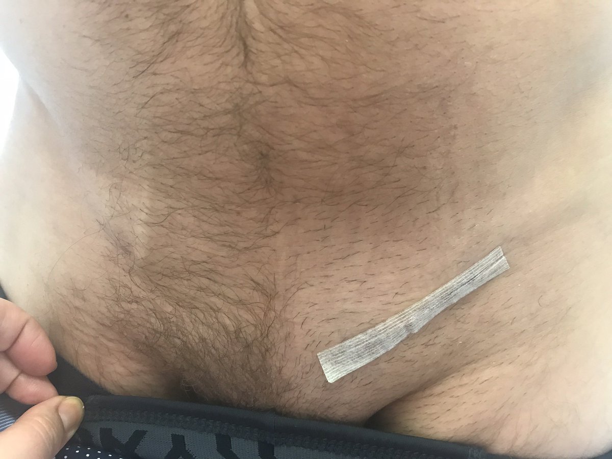 Department Of Surgery Inguinal Hernia