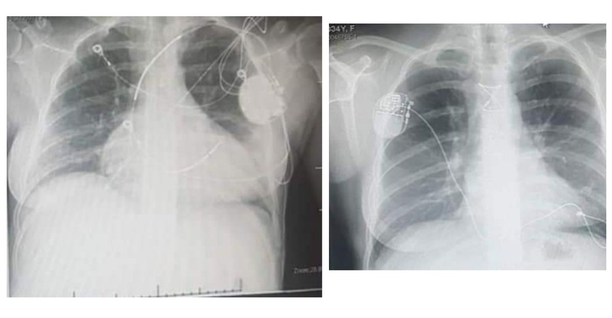 SweetestGiftAU's tweet photo. Pretty sure this is the best #10YearChallenge comparison - Miranda from our team, before and after her gift of life in the form of a new heart ❤️
@DonateLifeToday #donatelife #organdonation #thegreatestgift #thesweetestgift #transplantrecipient https://t.co/PQWRXGdhmq