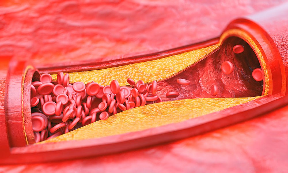 El sueño de mala calidad aumenta el riesgo de ateroesclerosis (acumulación de placas en las arterias de todo el cuerpo), según el estudio PESA CNIC-Santander, realizado por investigadores del Centro Nacional de Investigaciones Cardiovasculares (CNIC), que dirige Valentín Fuste...