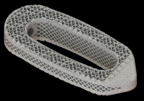 3dheals's tweet photo. Aries-L Patient Specific 3D Printed Spinal Device Implanted for the First Time⠀
@OsseusFS @josephspinectr #3dprinting #spinaldevice #titanium #implants #technology #healthcare #JointheTribe https://t.co/RyGokjS1mD https://t.co/MrTB5gZpce https://t.co/yvDmgUvwCh