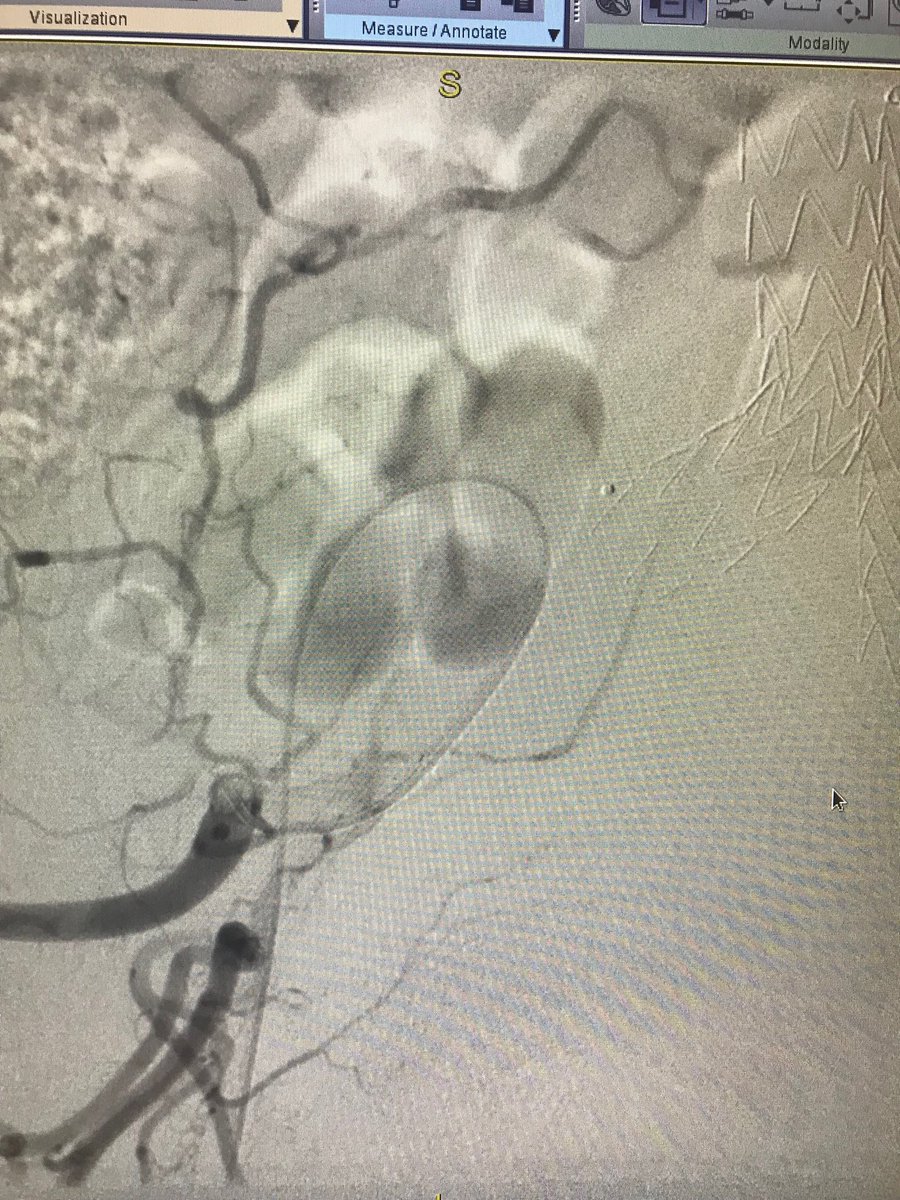 cfbechara's tweet photo. Type 2 endoleak with enlarging AAA, ipsi IIA, into iliolumbar #5Fr #microcatheter #coilembolization @pneumbra #rubycoils #Veterans ❤️ https://t.co/4d4feoN8vt