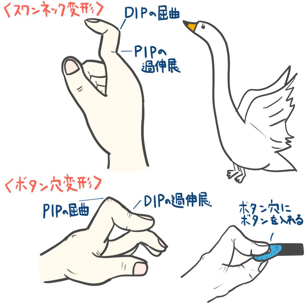 ゴロ 解剖生理イラスト 一瞬で覚える 関節リウマチの手指変形 試験中に分からなくなったら 自分のシャツのボタン穴にボタンを入れて見てください その時の手の形が そう ボタン穴変形です ゴロ 解剖生理イラスト 一瞬で覚える 関節リウマチの手指変形 試験中に分からなくなったら 自分のシャツのボタン穴にボタンを入れて見てください その時の手の形が そう ボタン穴変形です