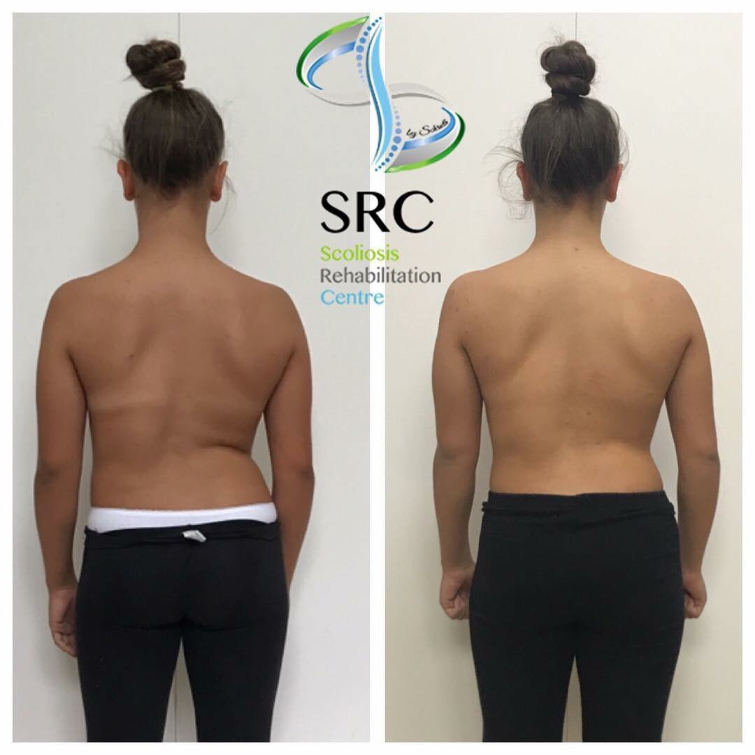 ScolioCentar's tweet image. Još jedan lep rezultat ☺️#scoliocentar #schrothmethod #schrothcamp #scoliosis