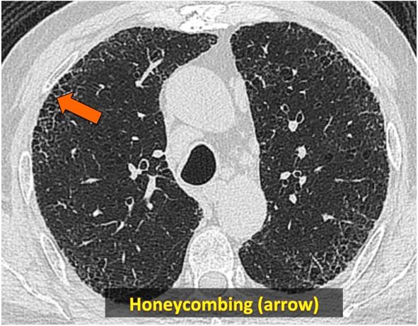 Rad_Bits's tweet photo. Answer Quiz220: Usual Interstitial Pneumonitis (Idiopathic Pulmonary Fibrosis in a Smoker)
#radbits #medschool #Medstudent #medical_student #medicaleducation #MedEd #foamed #FOAMrad #mrd13 #mrd14 #med15 #med16 #med102 #usmle #med20 #med19 #med18 #radcase #rsna18 #med101 https://t.co/C4PMiMau6q