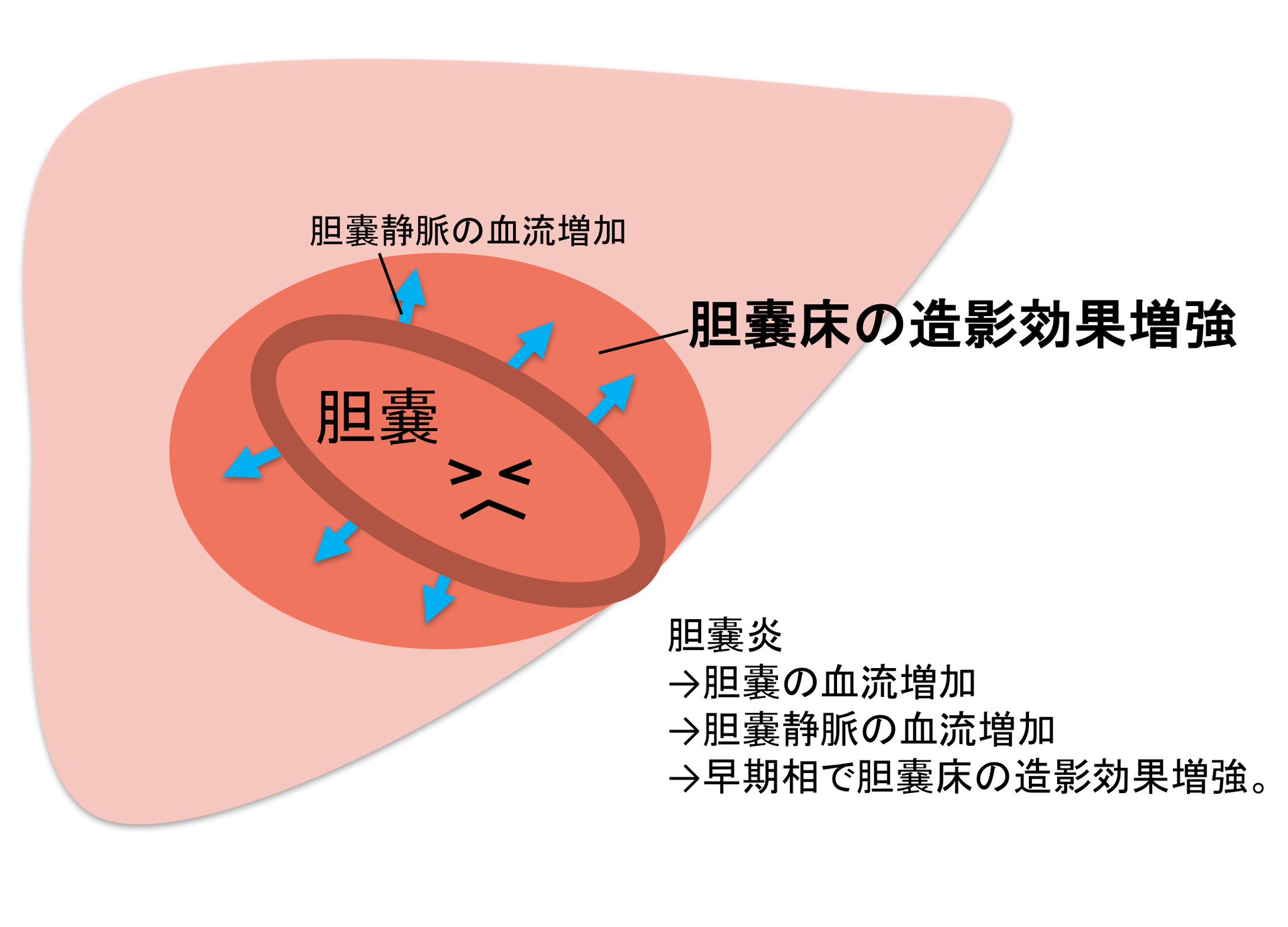 炎症 胆嚢