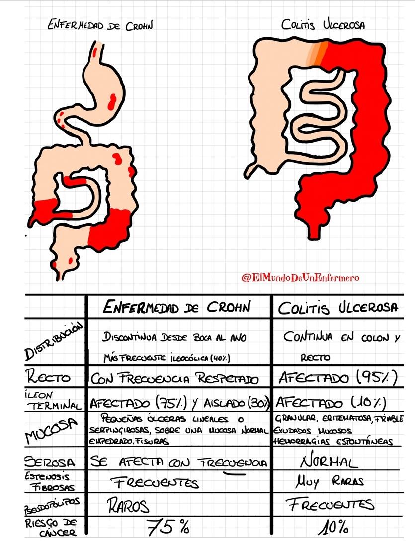 Ulcerative Colitis