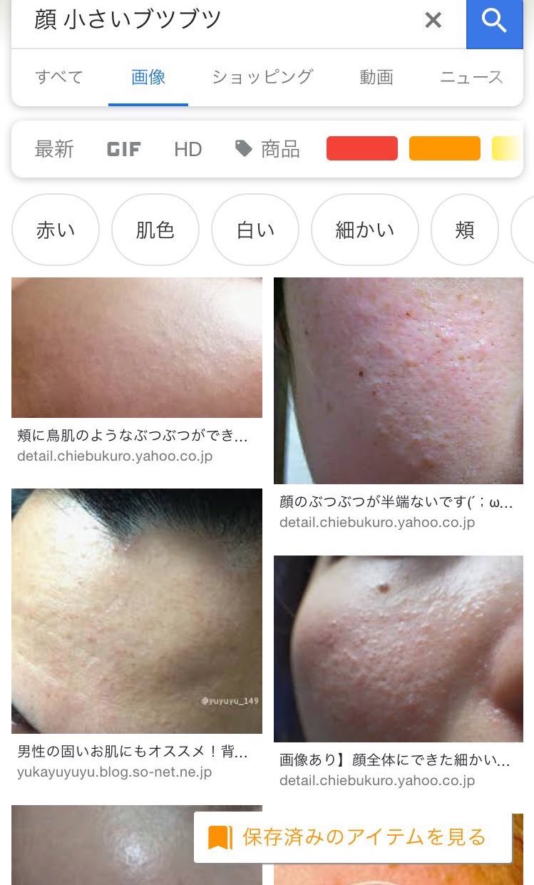 ごぼ美 顔脱毛 とにかく神です こめかみから頬にかけてあった小さなプツプツ 画像参照 が一掃された 顔にうぶ毛生えてて 毛穴やザラつき気になる人は絶対にやるべき T Co 3gypkpkig0 Twitter
