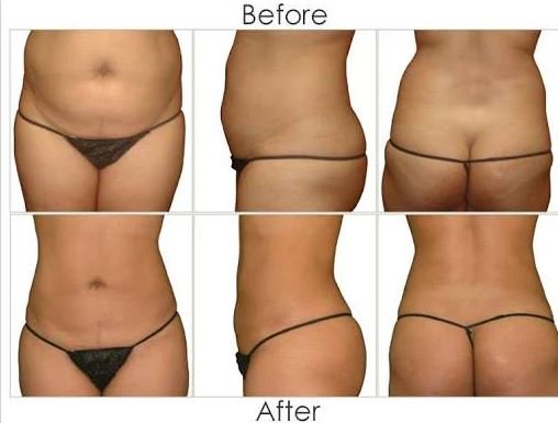 SculptIndia's tweet photo. Are you looking for the best #fat #removal method? #Liposuction #surgery helps in elimination of undesired #FatReduction that resist from works outs and #dieting. 

For more details visit https://t.co/3wi0H0kcVC

#bestliposuctionindelhi https://t.co/hVIyTcQ7D7