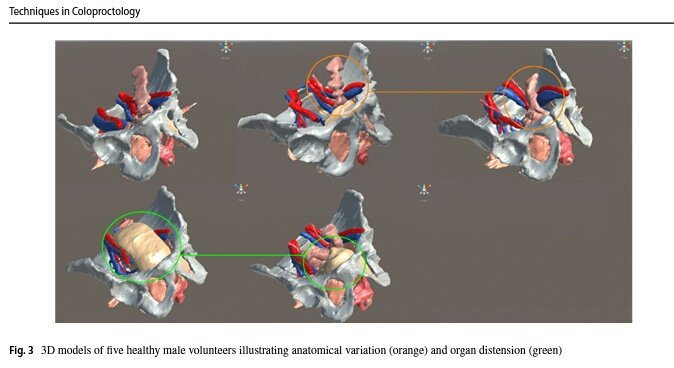 3D imaging and printing in pelvic colorectal cancer: ‘The New Kid on the Block’ An overview of applications of 3D imaging in #colorectalsurgery & description of the beautiful model created at their center by Christos Kontovounisios link.springer.com/article/10.100… #colorectalresearch