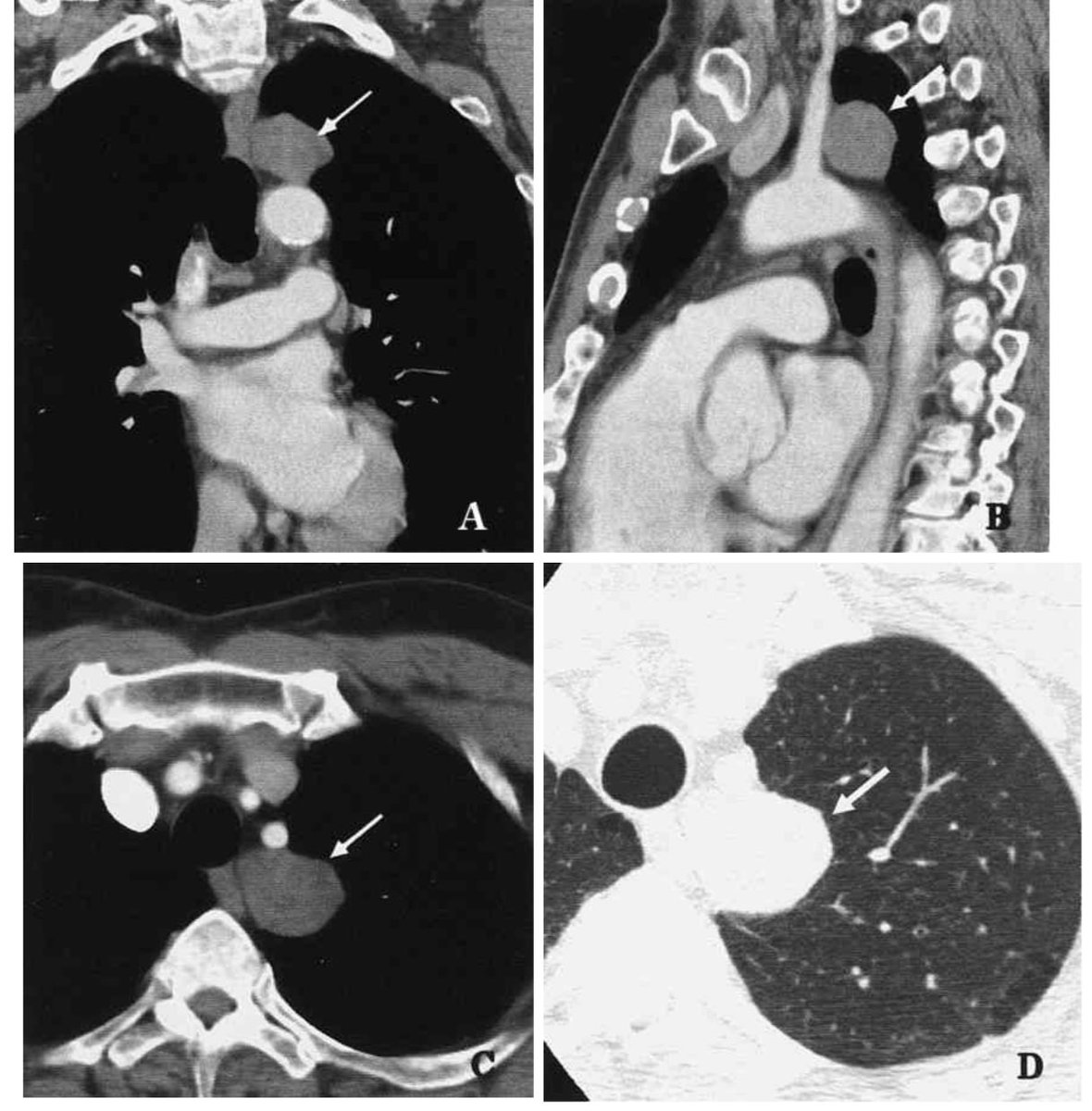 医師国家試験クイズくん 悪性と良性の鑑別にはfdg Petが有効 を覚えておきましょう ほかに悪性を疑う所見に 肺門縦隔のリンパ節腫大 3cm以上の腫瘍径 石灰化がないこと 良性はポップコーン状石灰化が多い スピキュラが存在すること 倍の