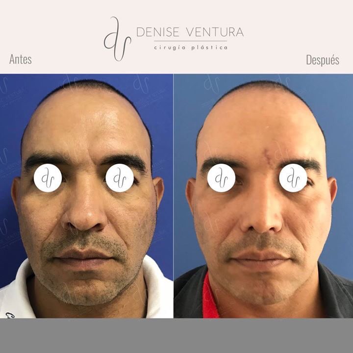 venturadenise's tweet image. En la foto se observa el antes y después (1 mes) de una #Rinoplastia en un paciente masculino, donde se realizó definición del dorso y de la punta nasal, manteniendo la armonía facial,resultados naturales!
Gracias a mi paciente por permitirme publicar las fotos con sus resultados