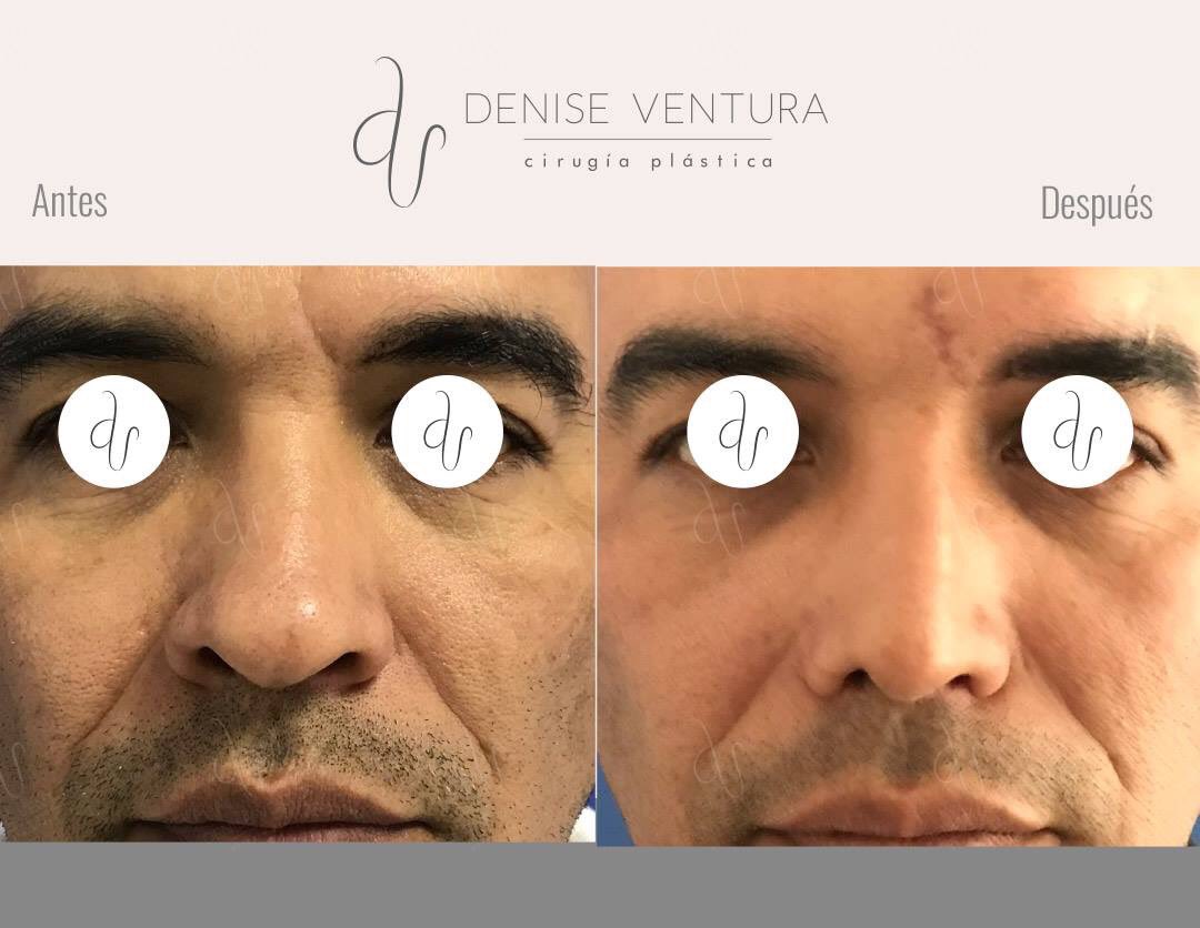 venturadenise's tweet image. En la foto se observa el antes y después (1 mes) de una #Rinoplastia en un paciente masculino, donde se realizó definición del dorso y de la punta nasal, manteniendo la armonía facial,resultados naturales!
Gracias a mi paciente por permitirme publicar las fotos con sus resultados