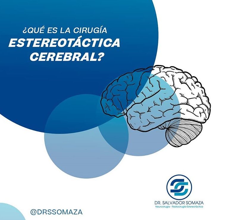 Qué es la Cirugía Estereotáctica Cerebral?
La Cirugía Estereotáctica Cerebral es una operación cerebral en la cual se utiliza un dispositivo o Guía Tridimensional (Marco Estereotáctico) que se ajusta a su cabeza.