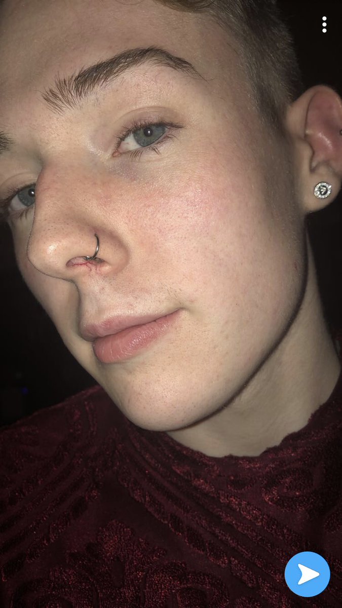 MasonMay7's tweet photo. Photo on the left makes me so uncomfortable but want to show my skin transformation. One eh the things that put me down for years. Ty dermatology 🤪🤪 https://t.co/CNeXbe75kc