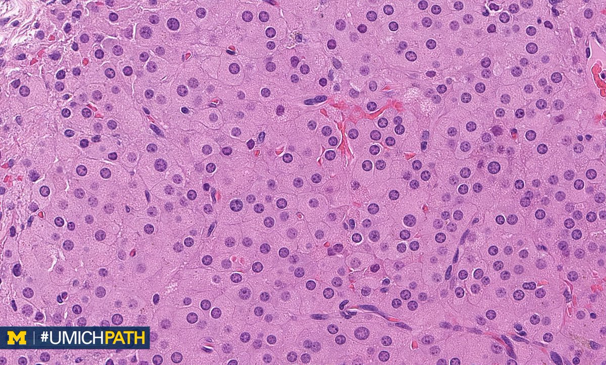 UMichPath's tweet photo. 🔬 This week’s theme: Gynecologic #Pathology
 
➡️ Day 1: What’s your #DailyDx of this ovary? Similar findings were present in both ovaries.

➡️ What could be associated with this finding?

➡️ We’ll tweet the answers &amp; some quick facts tomorrow!

#GYNPath https://t.co/HznfN9oiK6
