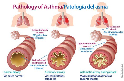 AndGzDz's tweet photo. Asthma https://t.co/kCfVxPNqkJ https://t.co/7UW8t51gDh