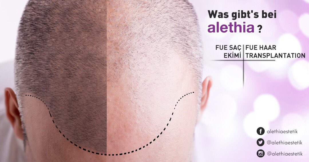 alethiaestetik's tweet image. ➡️Für natürlich aussehende, dickere und kräftige Haare entscheiden Sie sich für #FUE Methode
➡️Choose #FUE hair transplantation technic for natural looking, strong hairs
👉🏻Detaylı bilgi almak için;
📱0553 536 18 02 
#alethia #avrasyahospital #hairtransplant #hairtransplantation