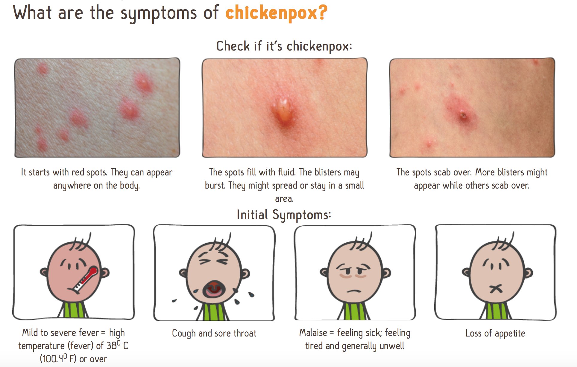 Mild Chicken Pox Pictures Early Stages