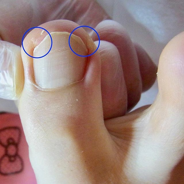 整体 フットケア専門院ペディスマイル 森崎幸代 Pedismile Twitter