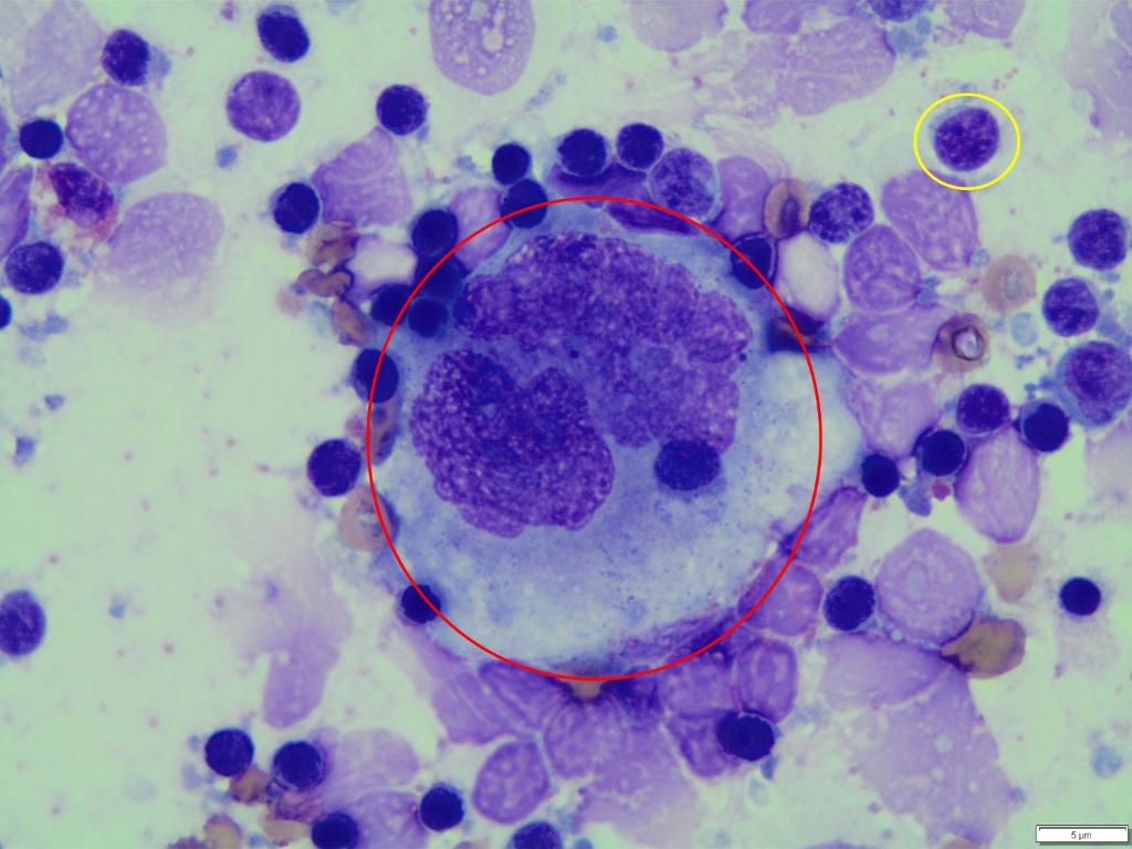 NCHforDocs's tweet image. This photomicrograph is taken from stained cytospin prepared from pleural fluid of a patient who presented with fatigue and was found to have an anterior mediastinal mass. What is the cell in red circle?
#PediPath #NCH_COTW #NCHPath