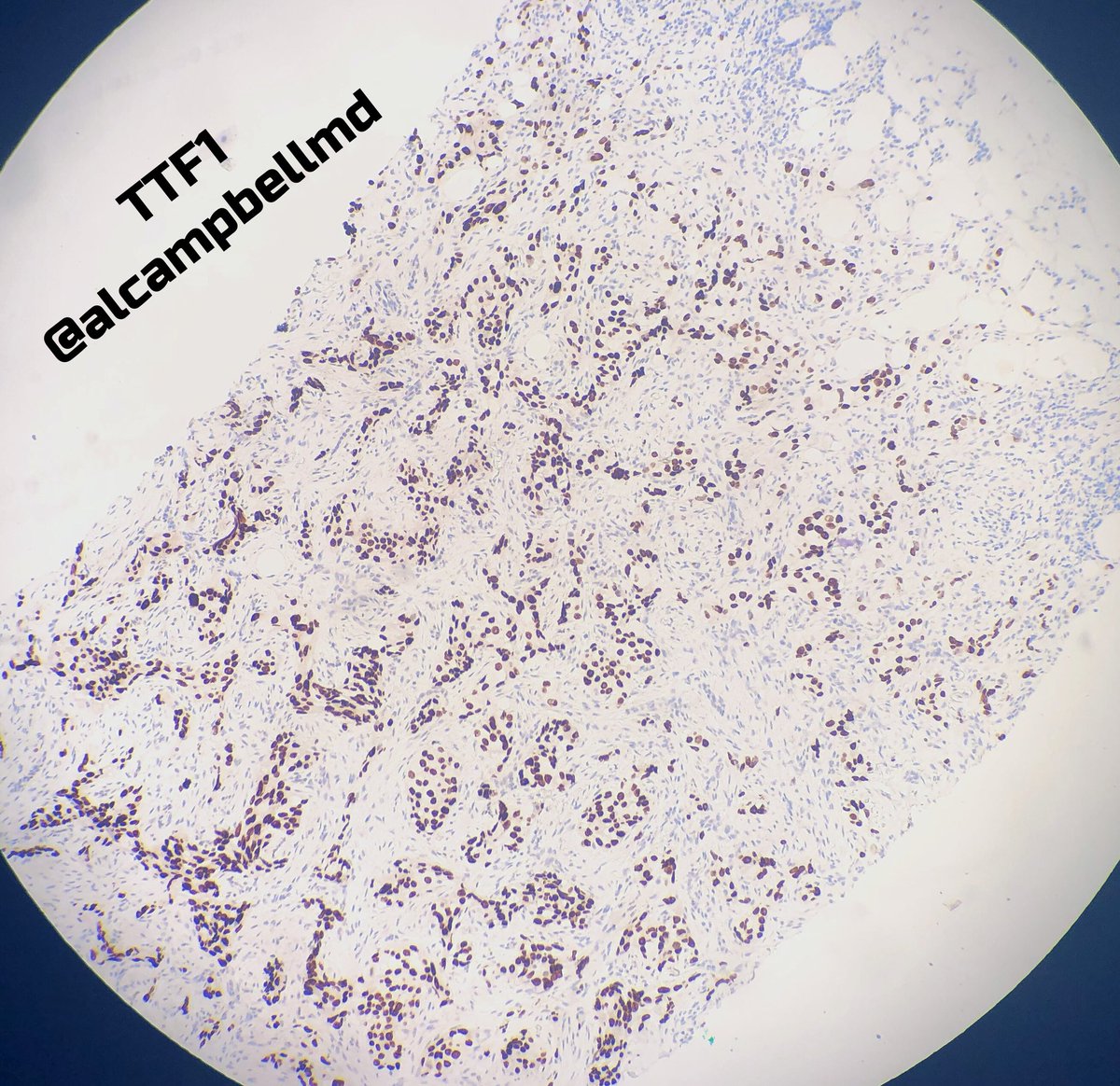 alcampbellmd's tweet image. Partner showed me this 65 yo female with a left breast mass at 12 o’clock. Also axillary lymph node that is positive with same. Morphology was a little odd so I suggested IHC. Uncommon example of metastatic lung adeno presenting as a primary breast mass. #Pathology #breastpath