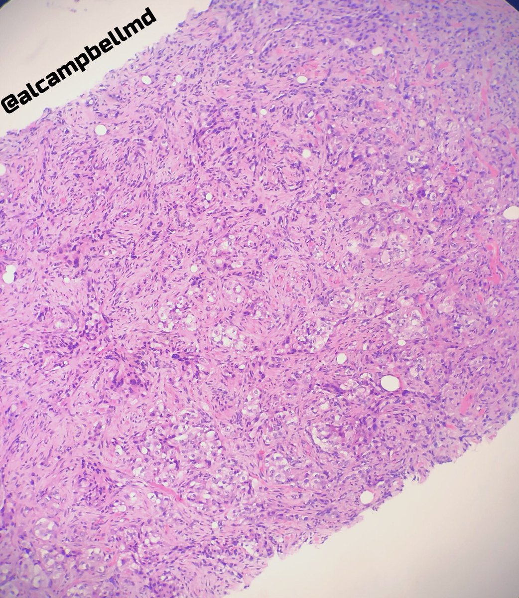 alcampbellmd's tweet image. Partner showed me this 65 yo female with a left breast mass at 12 o’clock. Also axillary lymph node that is positive with same. Morphology was a little odd so I suggested IHC. Uncommon example of metastatic lung adeno presenting as a primary breast mass. #Pathology #breastpath