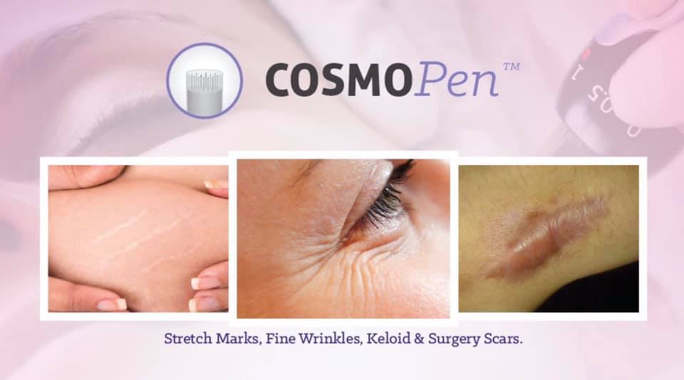 Introducing the #COSMOPen! COSMOPen is a state-of-the-art medical grade high speed #microneedling system, offering the same results as a fractional laser without pain, downtime, expense, &amp; thermal damage. COSMOPen can be used to treat acne, surgical scars, wrinkles, &amp; more!