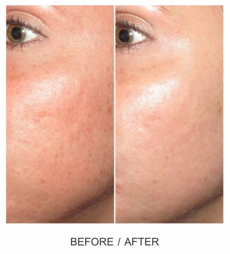 🚨SPECIAL OFFER ALERT!🚨 

Save $150 on your FIRST #microneedling treatment! 

Limited promos and appointments! Call today! 201-313-8899
 
* Please note this a medical-grade treatment with needle depths up to 2.5 mm (NOT a spa-grade treatment). *