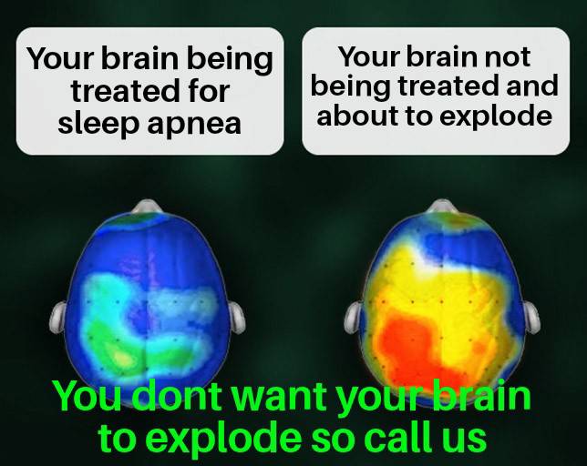 gutter2glory4u's tweet image. Dont let your brain explode one day. It would be messy. Instead get a sleep study and get treatment. Like &amp;amp; SHARE.  #cpap #homesleepstudy #sleepapnea #sleep #snoring #sleepapneasymptoms #sleepapneatreatment