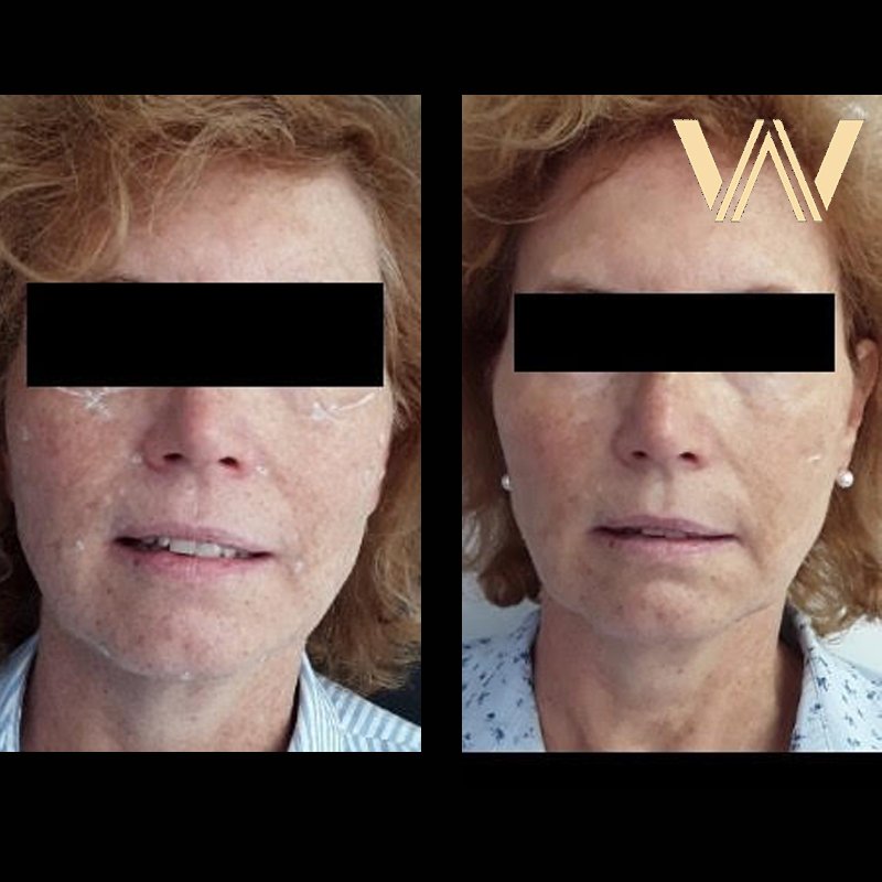 #DermalFillers can be used for more than just corrective and volumizing lip procedures - including augmenting the jaw area to improve proportion, definition, and restore elasticity - as seen in our latest #jawfiller treatment photos! Call the team on 01344 98514 to find out more.