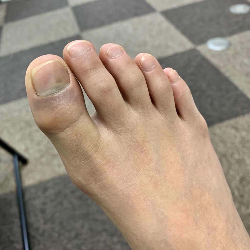 なつめ整骨院 内藤 なつめの日常 ー 右母趾末節骨骨折 ー スケールの大きいサッカー少年が サッカーボールだけでは飽き足らず 地球も一緒に蹴ったことで足の親指を骨折 その結果 学校のマラソン大会と今週末のサッカー練習試合の欠場が決まった