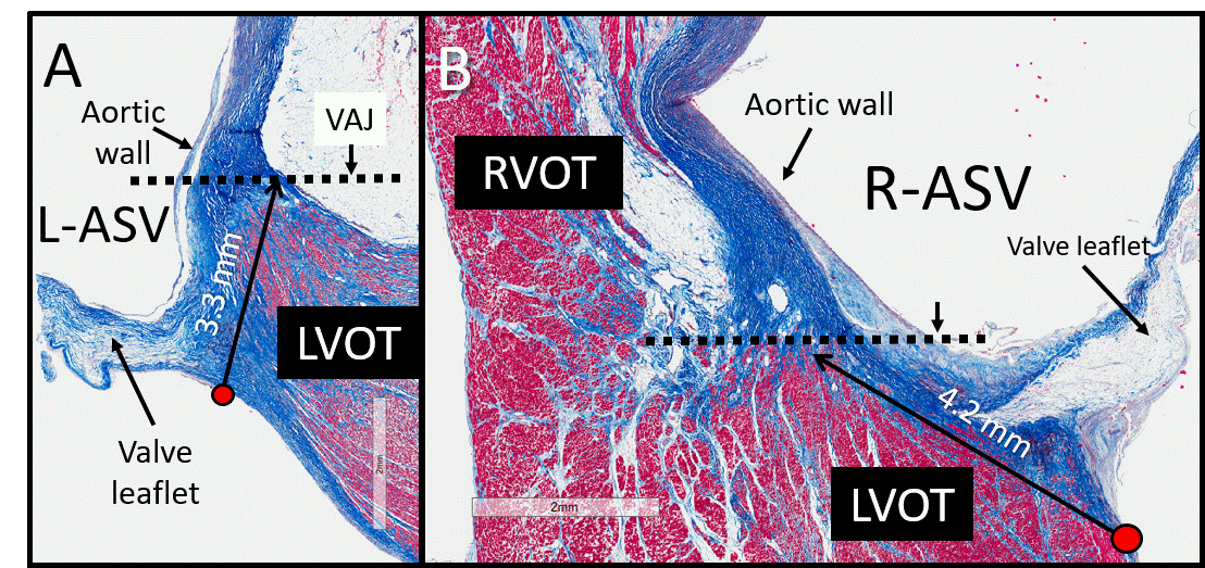 Our State-of-the-Art review in #JACCCEP on approach to LVOT arrhythmias. Anatomy is key! electrophysiology.onlinejacc.org/content/5/1/1

<a href="/JACCJournals/">JACC Journals</a> <a href="/WeillCornell/">Weill Cornell Medicine</a> <a href="/nyphospital/">NewYork-Presbyterian</a>